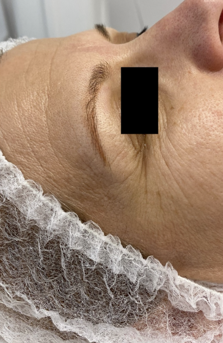 Phorma Laser kezelés előtt készült fotó