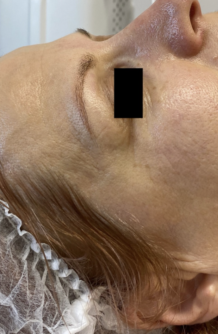 Phorma Laser kezelés után készült fotó